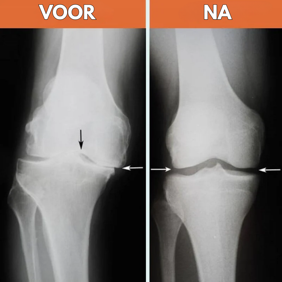 FisioKnie™ - Kniepijn weg, beweging op volle kracht